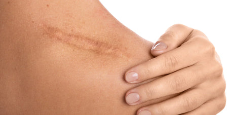 Pourquoi ne pas exposer une cicatrice au soleil ?